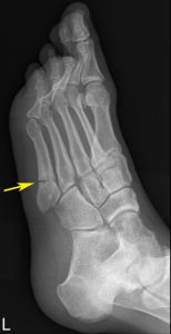 Neymar Jr / Foot Fracture (Metatarsal) - IDOR 2019 - Sports Imaging