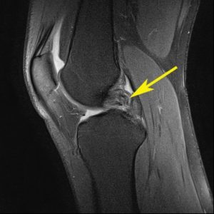 Connor McDavid / Knee Ligament Tear - IDOR 2019 - Sports Imaging