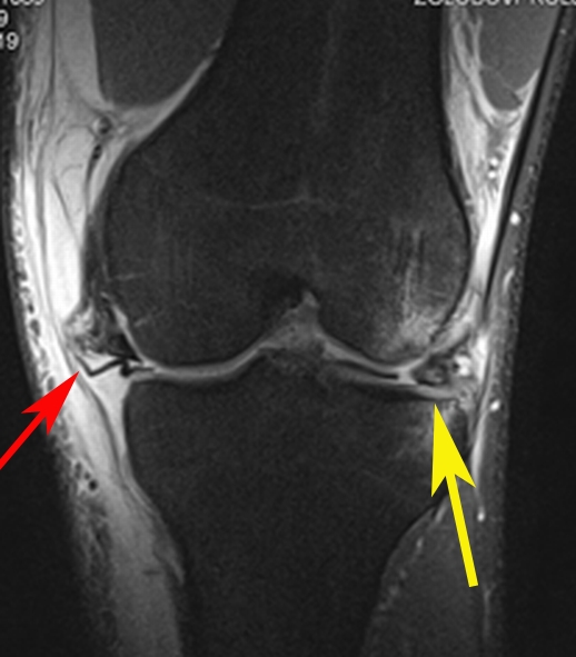 Stephanie Brunner / Knee Ligament Tear - IDOR 2019 - Sports Imaging